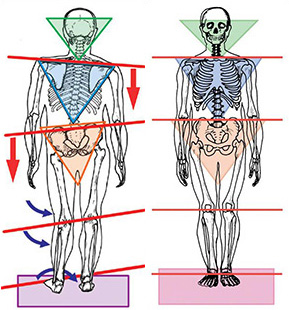 Image of two bodies; one with a crooked neck, shoulders, spine, pelvic bone, and legs; they other in perfect body alignment.